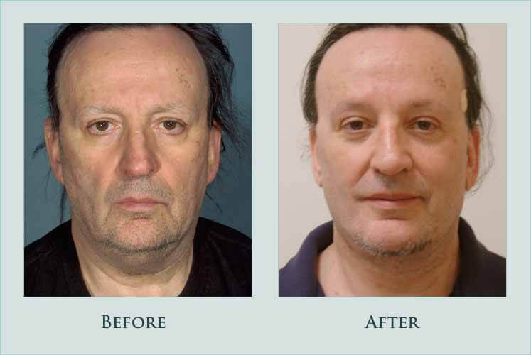 Before/after photos of procedure performed by Dr. Caroline Min - This patient is shown 4 months after face and necklift.