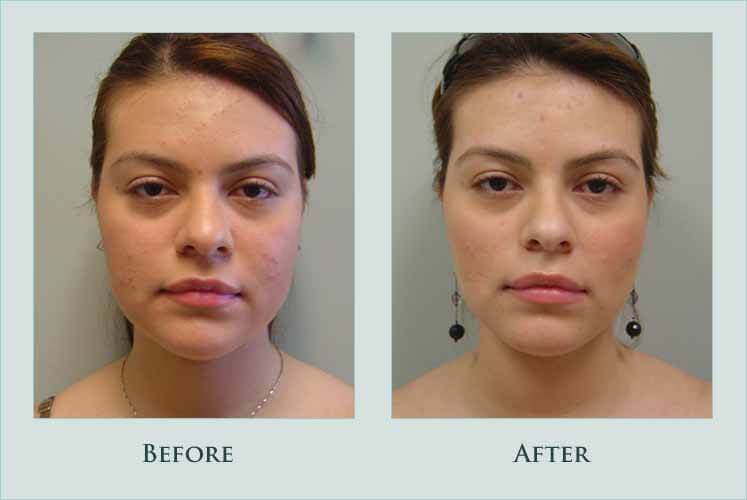Before/after photos of procedure performed by Dr. Caroline Min - This is a 21 year old patient who disliked the roundness of her face and excess fat underneath the chin. She underwent liposuction of the neck and excision of buccal (cheek) fat. Post-operatively, her face appears thinner, although she did not lose weight.