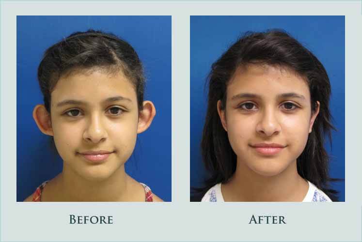 Before/after photos of procedure performed by Dr. Caroline Min - This is a 13 year old girl who disliked the appearance of her protruding ears. She underwent otoplasty and is shown 7 months after surgery.