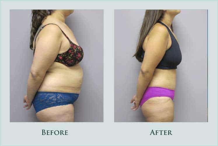 body abdominoplasty case before after picture