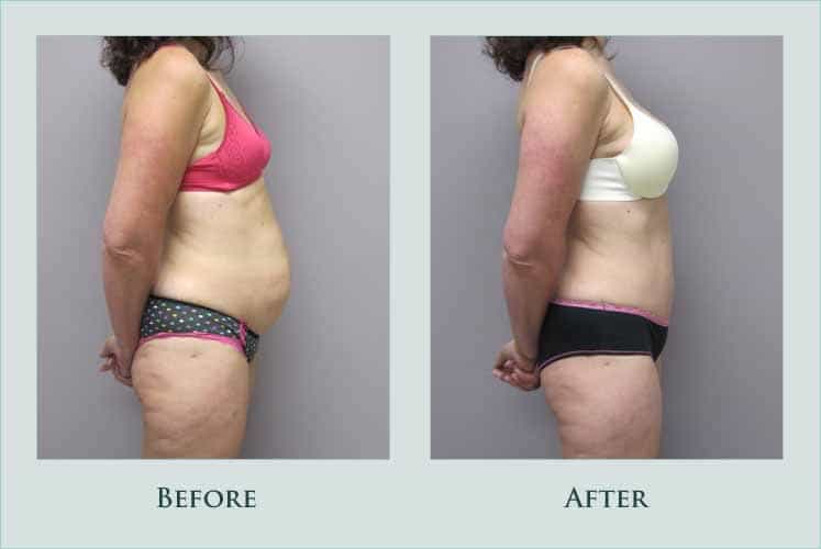 body abdominoplasty case before after picture