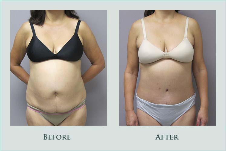 Before/after photos of procedure performed by Dr. Caroline Min - undefined