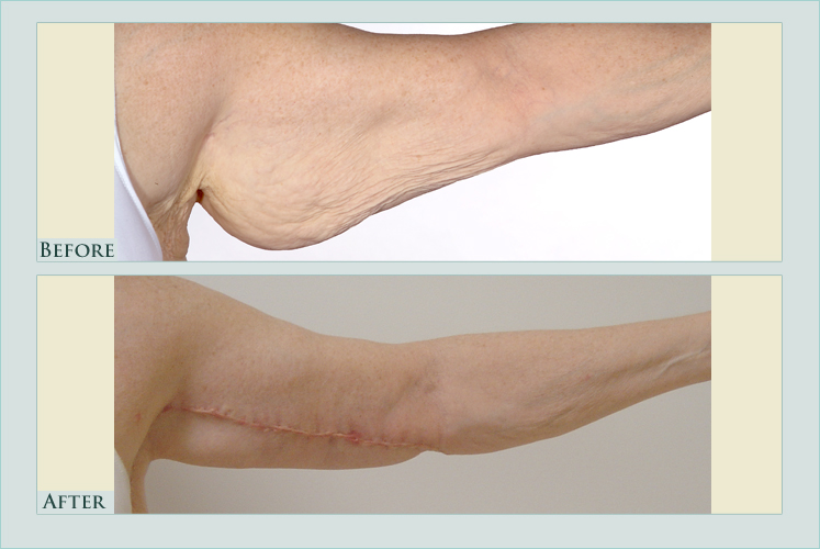body arm-lift case before after picture