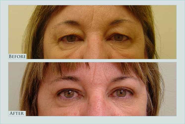 Before/after photos of procedure performed by Dr. Caroline Min - This is a 53 year old patient who is shown approximately 3 months after upper eyelid lift (blepharoplasty).