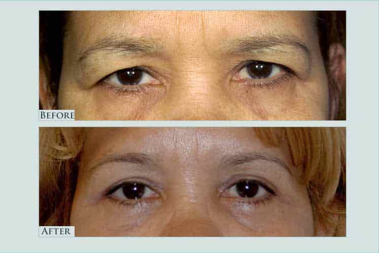 Before/after photos of procedure performed by Dr. Caroline Min - This patient is shown 3 months after undergoing upper and lower eyelid lift (blepharoplasty).