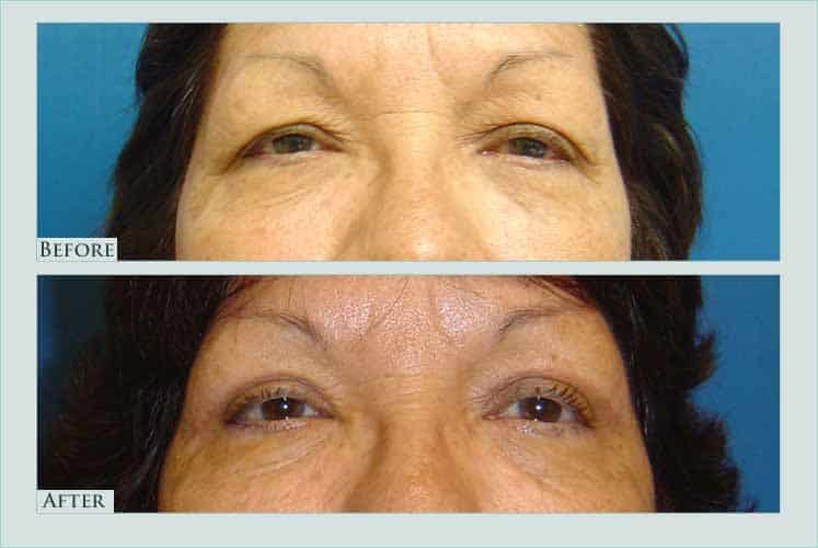 Before/after photos of procedure performed by Dr. Caroline Min - This is a 64 year old female patient who is shown 3 months after undergoing upper eyelid lift (blepharoplasty).