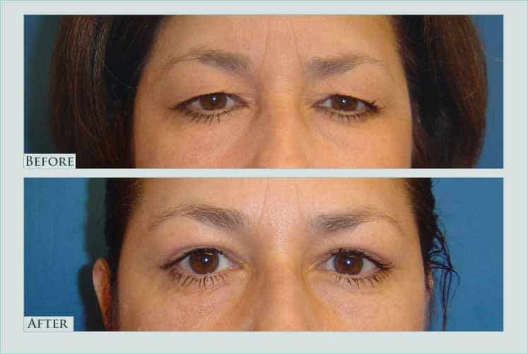 Before/after photos of procedure performed by Dr. Caroline Min - This is a 48 year old patient who had a large amount of excess upper eyelid skin. She is shown 2 months after undergoing upper eyelid lift (blepharoplasty).