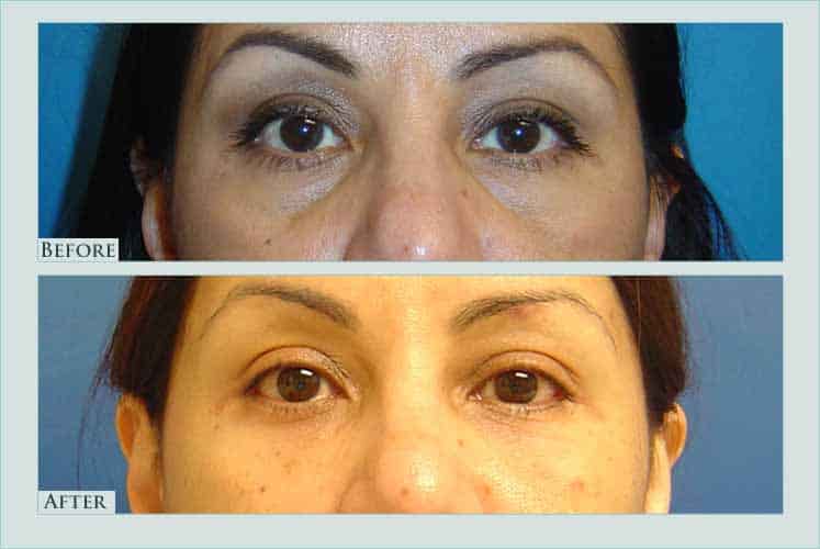 Before/after photos of procedure performed by Dr. Caroline Min - This is a 46 year old patient who desired improvement in the appearance of her lower eyelids. She disliked the puffy bags and the hollow grooving (known as the "tear through") underneath the eyes. She underwent lower eyelid lift and several sessions of fat grafting to fill out the hollow areas.