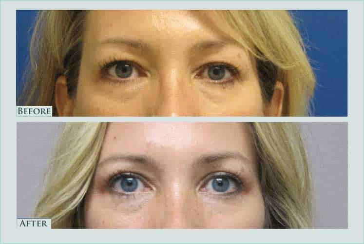 Before/after photos of procedure performed by Dr. Caroline Min - This is a 40 year old woman who is shown 6 months after undergoing upper eyelid lift.