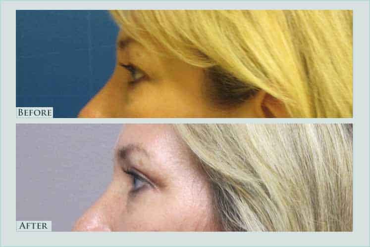 face blepharoplasty case before after picture