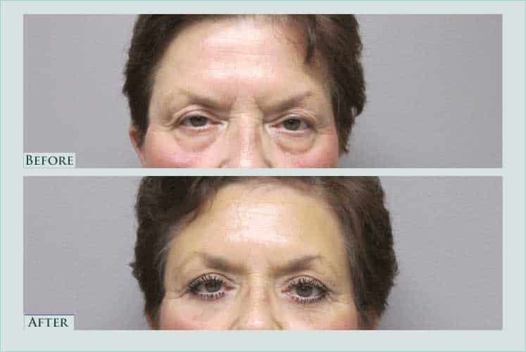 Before/after photos of procedure performed by Dr. Caroline Min - This is a 64 year old female who underwent upper and lower eyelid lift and endoscopic browlift. She is shown 6 weeks after her surgery.