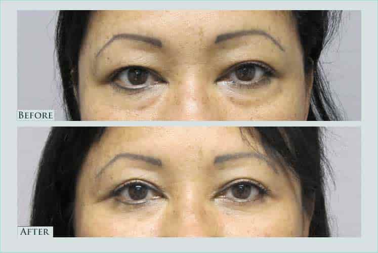 Before/after photos of procedure performed by Dr. Caroline Min - This is a 49 year old female who is shown approximately 6 months after undergoing bilateral upper and lower eyelid lift.