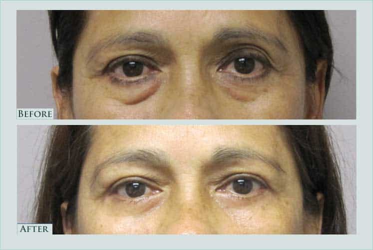Before/after photos of procedure performed by Dr. Caroline Min - This is a 57 year old female who is shown approximately 3 months after undergoing bilateral lower eyelid lift.