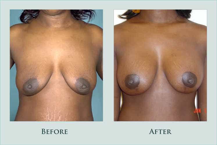 breast breast-augmentation-and-lift case before after picture
