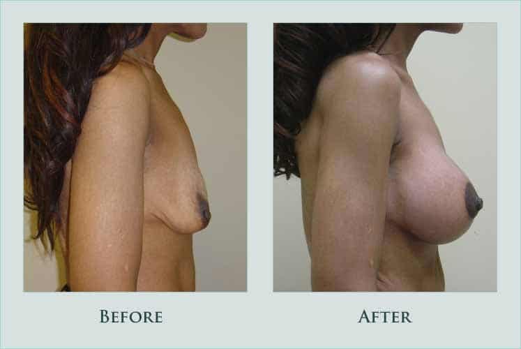 breast breast-augmentation-and-lift case before after picture