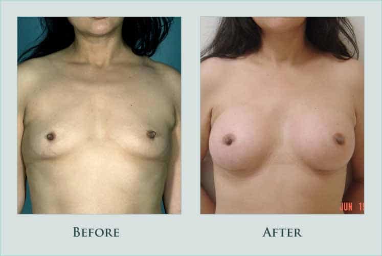 Before/after photos of procedure performed by Dr. Caroline Min - This is a patient in her 30s who was an AA/A cup and wished to be augmented to a small C cup. She underwent breast augmentation with 350 cc saline implants that were placed beneath the pectoralis muscle using an incision at the breast fold. She is shown 2 months after surgery.