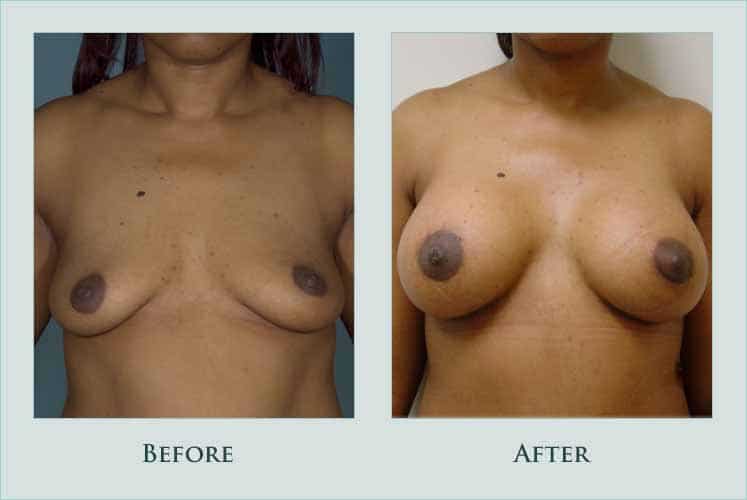 Before/after photos of procedure performed by Dr. Caroline Min - This is a young mother whose breasts became smaller and droopier after breast feeding 2 children. She underwent breast augmentation with 375 cc saline implants placed underneath the pectoralis muscle. The incision is at the areolar border and is barely visible. She is shown 2 months after surgery.