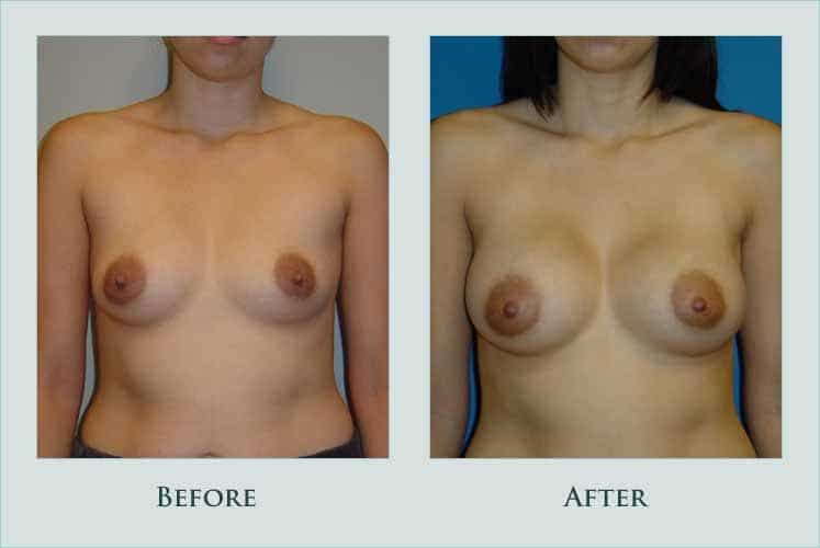 Before/after photos of procedure performed by Dr. Caroline Min - This is a 25 year old patient whose preoperative bra size was 34 A. She underwent breast augmentation with saline implants placed under the muscle through an incision at the inframammary fold. Because she was smaller on one side, the left side was filled to 370 cc and the right side was filled to 340 cc. She is shown 2 months after surgery.