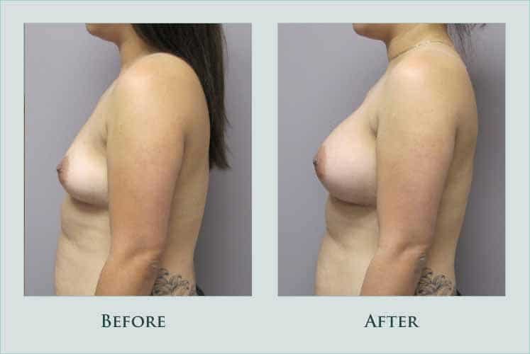 breast breast-augmentation case before after picture