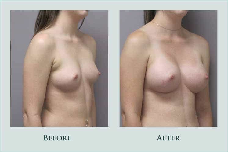 breast breast-augmentation case before after picture