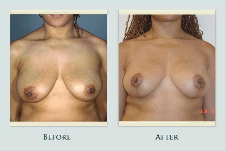 breast breast-lift case before after picture