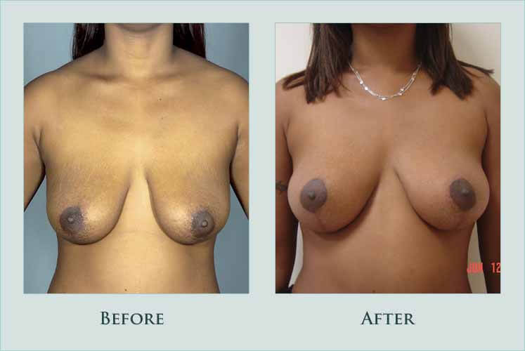 breast breast-lift case before after picture