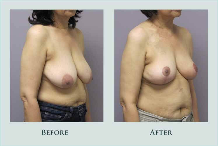 breast breast-reconstruction case before after picture