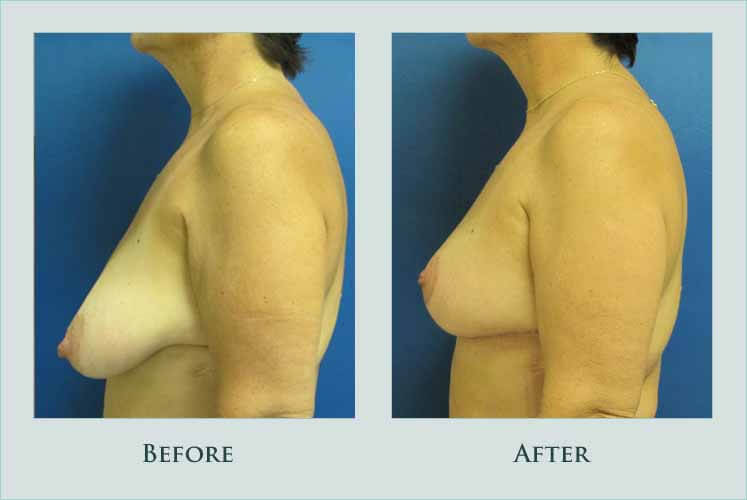 breast breast-reconstruction case before after picture