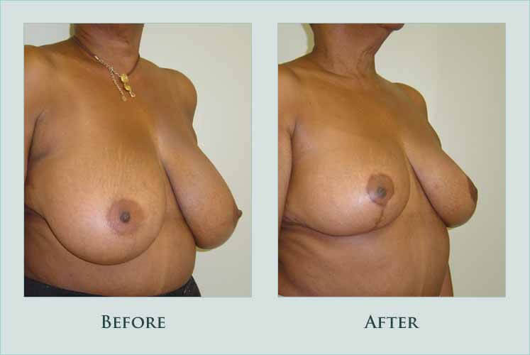 breast breast-reduction case before after picture