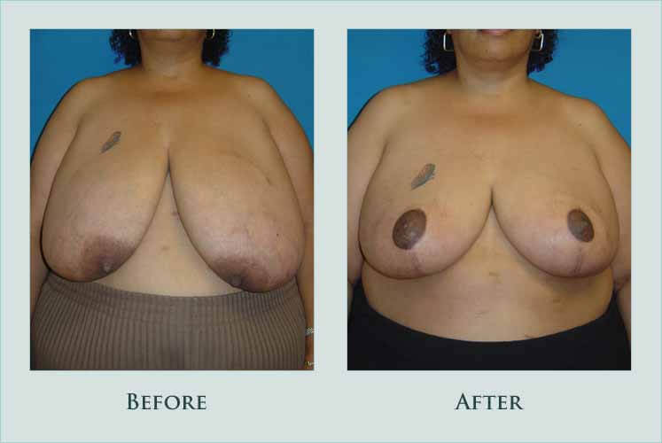 breast breast-reduction case before after picture