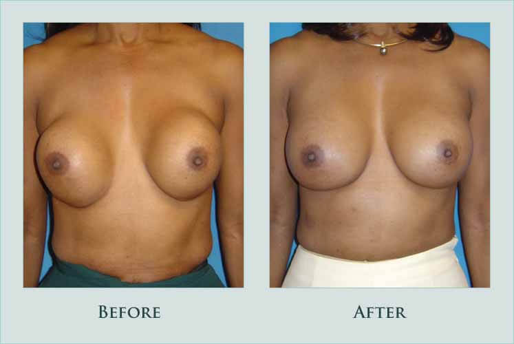 breast breast-revision case before after picture