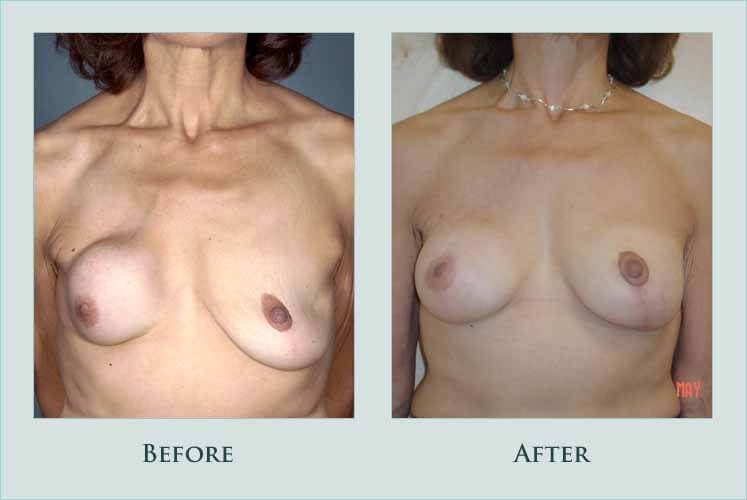 breast breast-revision case before after picture
