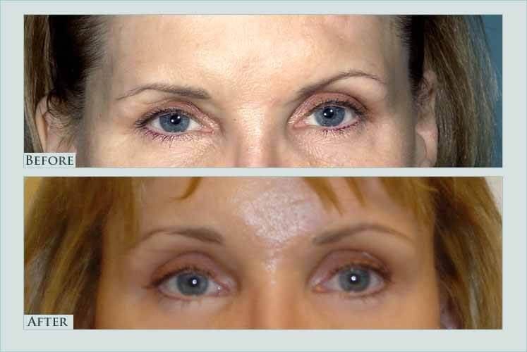 Before/after photos of procedure performed by Dr. Caroline Min - This patient had an upper eyelid lift years ago but the low position of her eyebrows was not addressed. She is shown 3 months after undergoing endoscopic browlift.