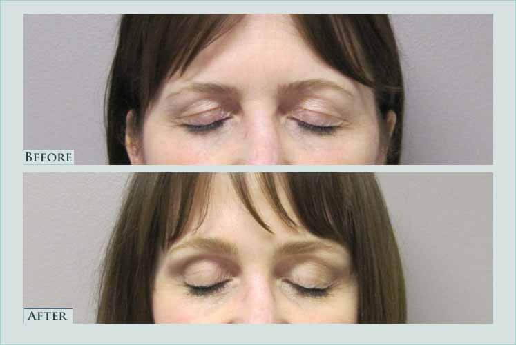 face browlift case before after picture