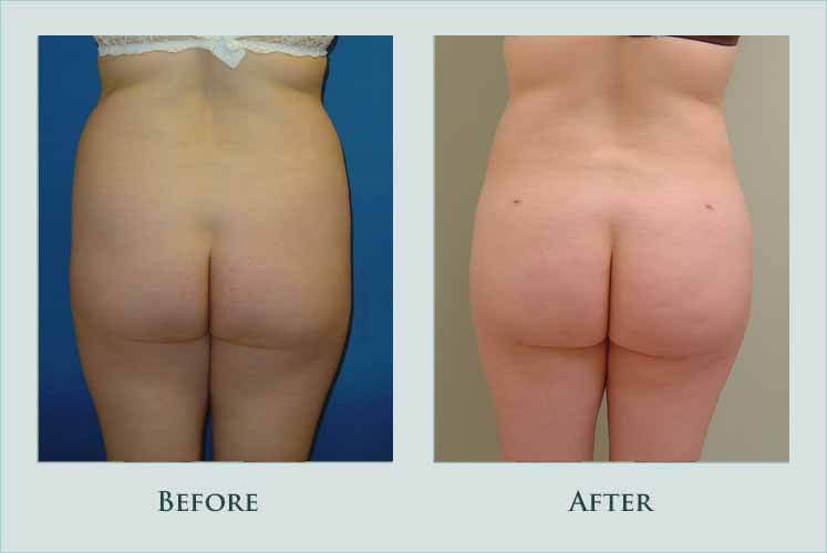 body buttock-augmentation case before after picture