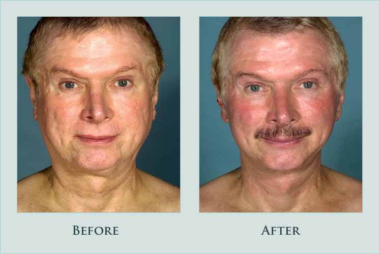 Before/after photos of procedure performed by Dr. Caroline Min - This patient is shown 4 months after facelift and fat transfer to the lips.