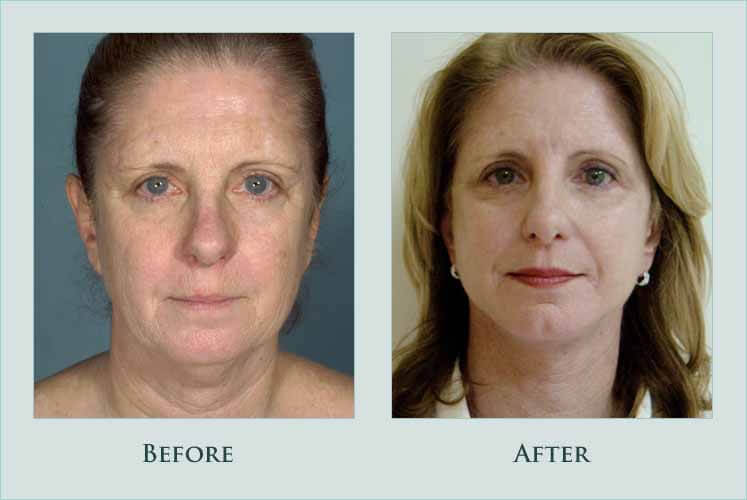 Before/after photos of procedure performed by Dr. Caroline Min - This patient wanted to look younger to match her vibrant personality and lifestyle. She is shown 4 months after facelift surgery.