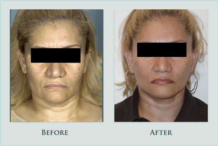 Before/after photos of procedure performed by Dr. Caroline Min - This is woman in her late 40s who had a short scar facelift to improve the aging appearance of her face. She is shown 4 months after surgery.