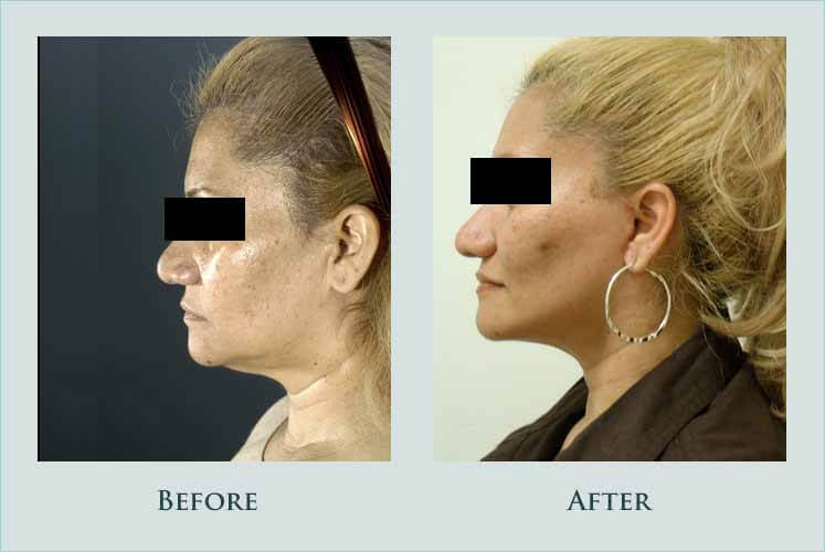 face facelift case before after picture