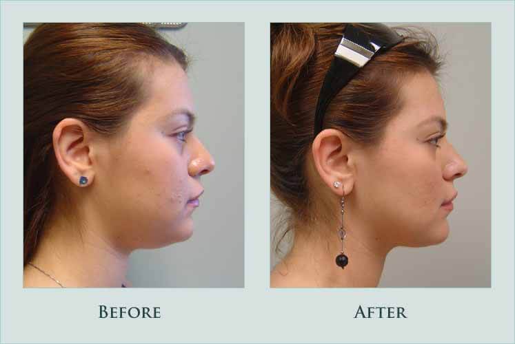 face facial-liposuction case before after picture
