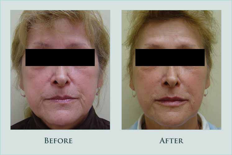 Before/after photos of procedure performed by Dr. Caroline Min - This patient disliked the lines around her lips and lower face. This was improved by injection of restylane and perlane into the lips, nasolabial folds, and mouth corners.