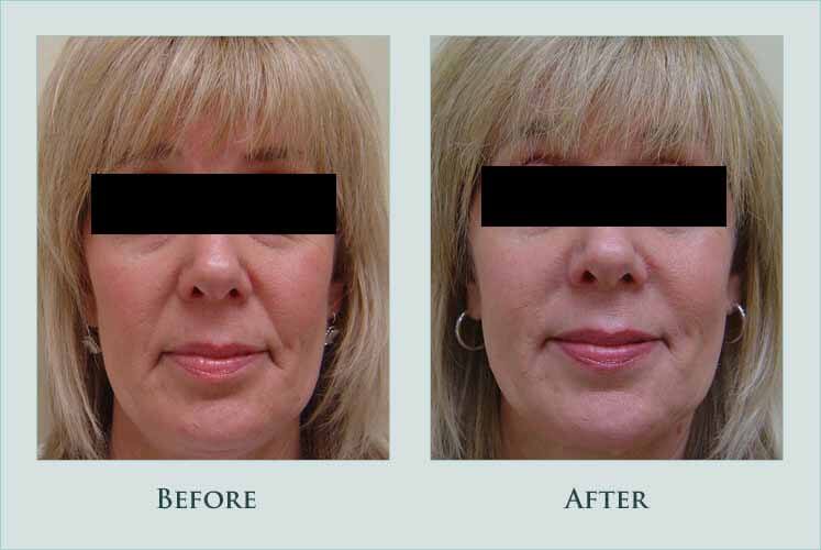 Before/after photos of procedure performed by Dr. Caroline Min - This is a 55 year old woman who had a combination of restylane and perlane injected into the nasolabial folds and mouth corners.