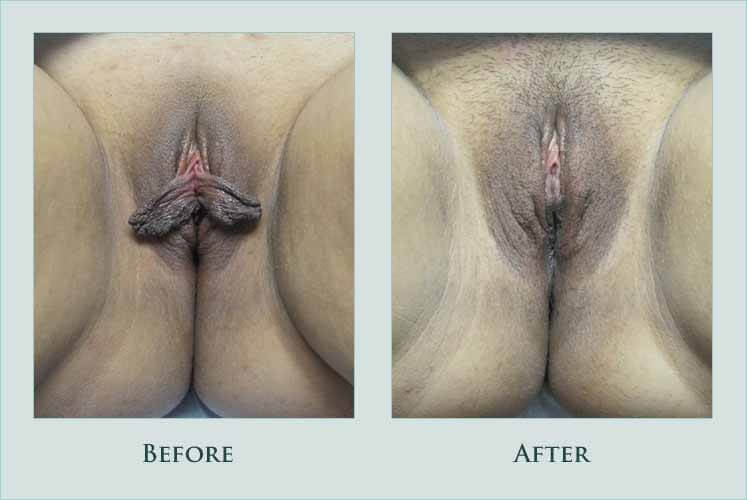 body labiaplasty case before after picture
