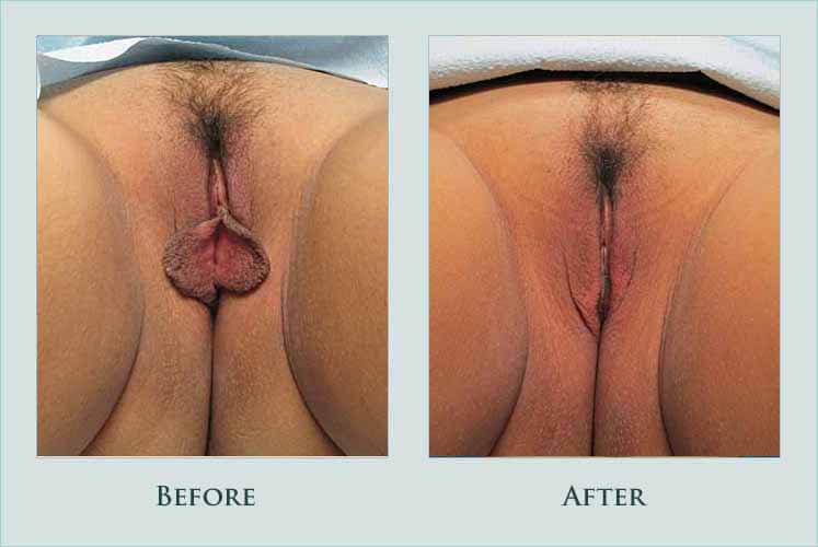 body labiaplasty case before after picture