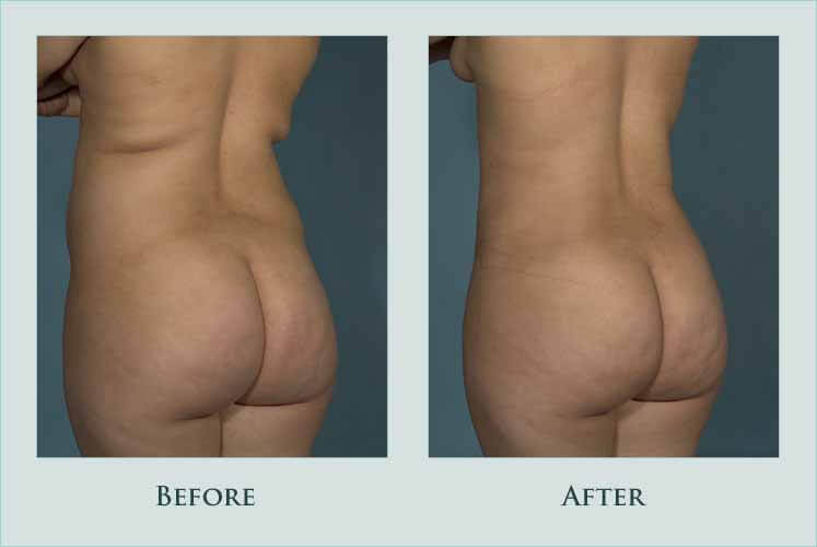 body liposuction case before after picture