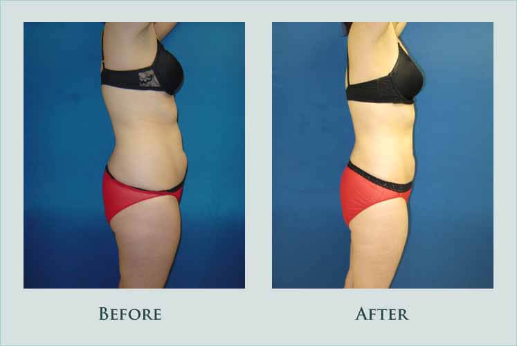 body liposuction case before after picture