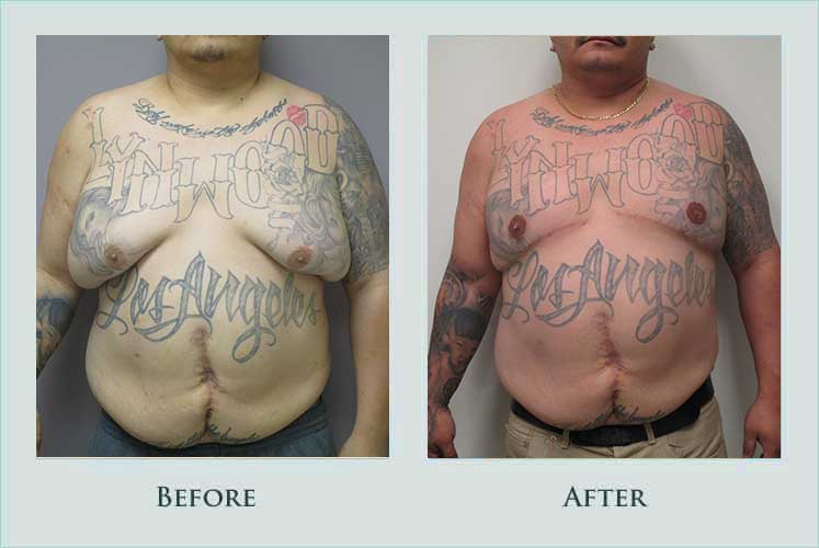 breast male-breast-reducstion case before after picture