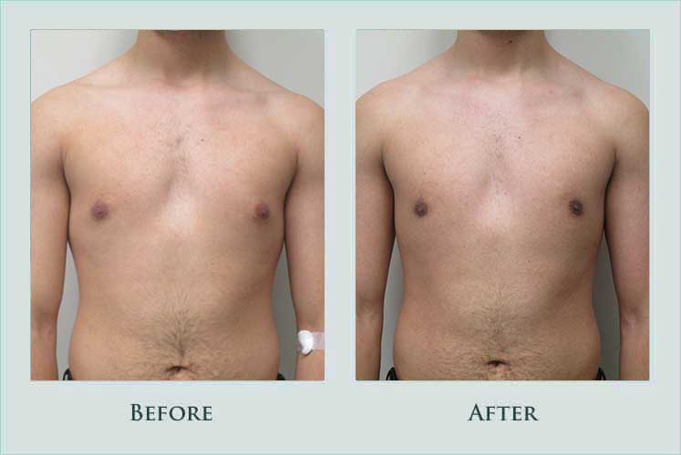 breast male-breast-reducstion case before after picture
