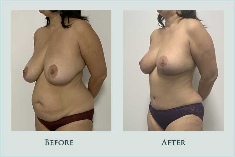 body mommy-makeover case before after picture