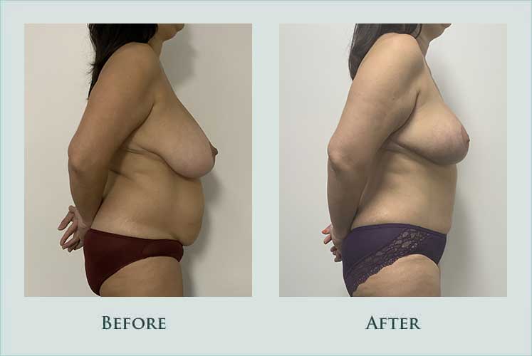 body mommy-makeover case before after picture